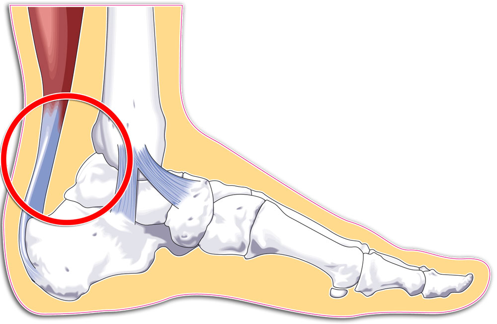 4176-188550-17tendon.jpg