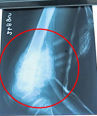 șa arată, pe radiografie, tumora (medalion) de la piciorl