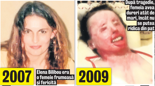 Exclusiv | O femeie din Rădăuţi, arsă cu acid pentru greşeala soţului | Imagini șocante