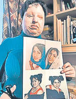 Exclusiv | O femeie din Rădăuţi, arsă cu acid pentru greşeala soţului | Imagini șocante