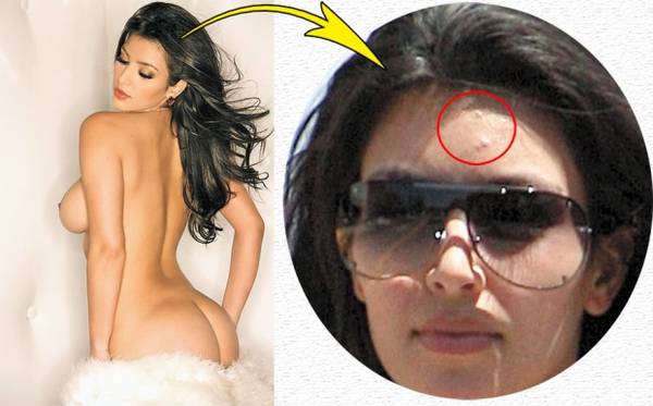 Foto | Și vedetele se luptă cu coșurile