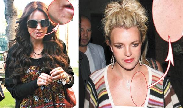 Foto | Și vedetele se luptă cu coșurile