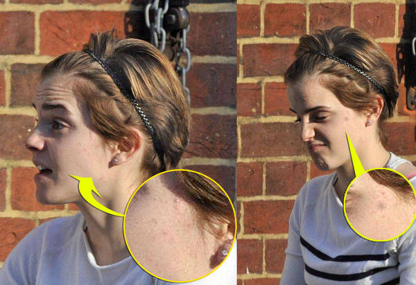 Foto | Și vedetele se luptă cu coșurile