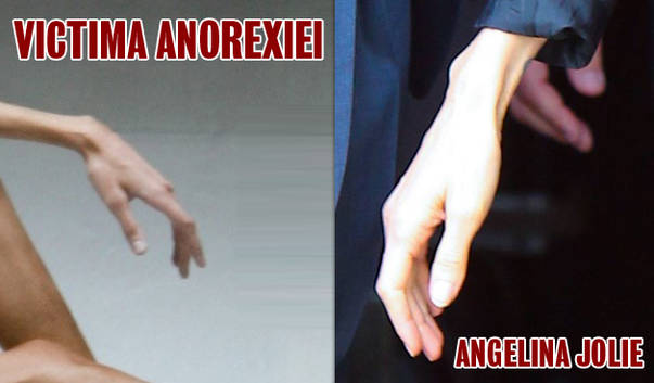 angelina jolie anorexica