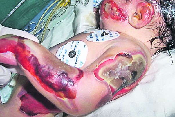 După ce a fost uitat în incubator, bebeluşul a suferit arsuri grave pe aproape tot corpul. Urmele rănilor au rămas mult timp pe trupul micuţului