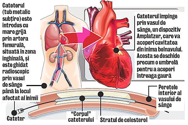 Angioplastie coronariană