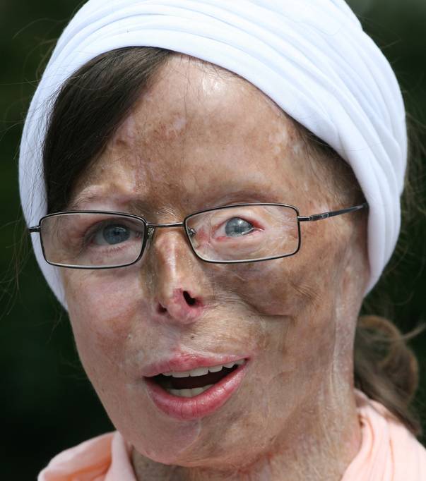 Patricia Lefranc, femeia mutilata cu acid de catre logodnicul ei