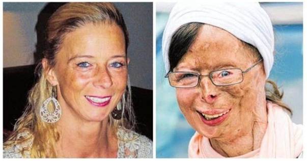 Patricia Lefranc, înainte şi după ce logodnicul i-a aruncat acid sulfuric pe faţă