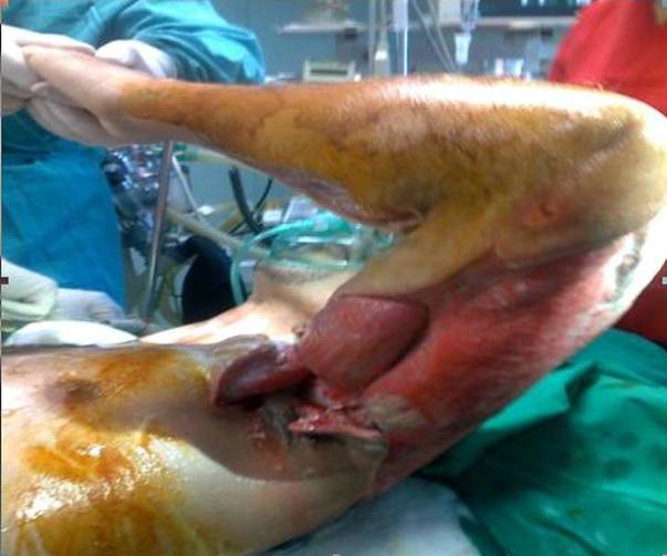 Drogurile  „te mănâncă de viu!" La propriu! Povestea unui dependent de heroină salvat de la moarte! ATENTIE! IMAGINI ŞOCANTE!