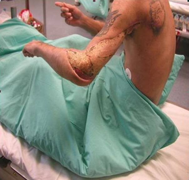 Drogurile  „te mănâncă de viu!" La propriu! Povestea unui dependent de heroină salvat de la moarte! ATENTIE! IMAGINI ŞOCANTE!