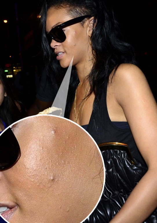 Rihanna cu faţa plină de coşuri