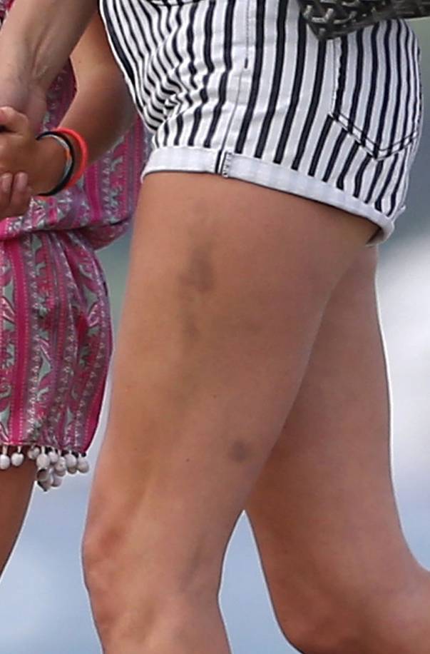 Kate Moss, plină de vănătăi. Uite în ce hal arată picioarele ei! | FOTO