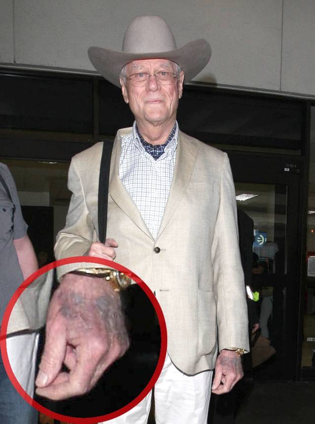 Larry Hagman e grav bolnav