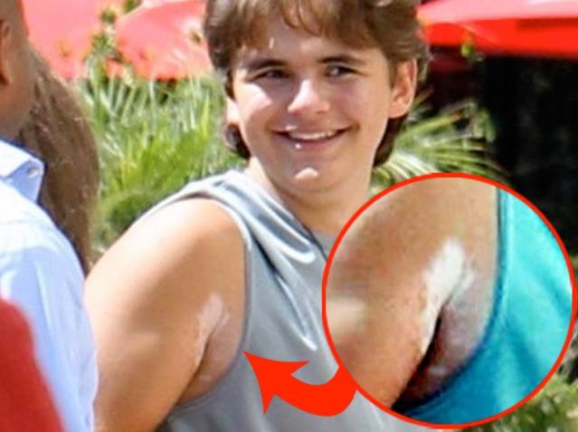 Prince Jackson are vitiligo, la fel ca tatăl său, Michael Jackson