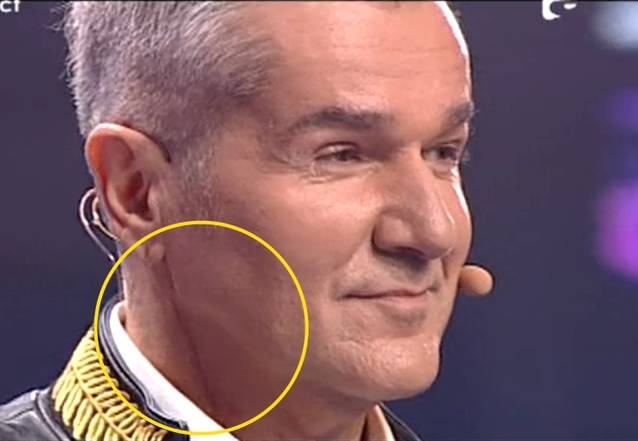 Dan Bittman, IMAGINE ŞOCANTĂ! Uite cum arată CICATRICEA DE LA OPERAŢIA PE CAROTIDĂ | FOTO ÎN ARTICOL