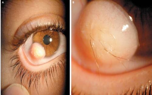 ŞOCANT! Îi creşte păr în ochi! FOTO DIZGRAŢIOS