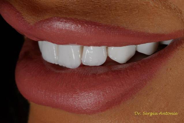 Bianca Drăgușanu, cu DINȚII PERFECȚI, dar BUZELE MUTILATE! Vezi ÎN ARTICOL imaginile care te pun pe gânduri!