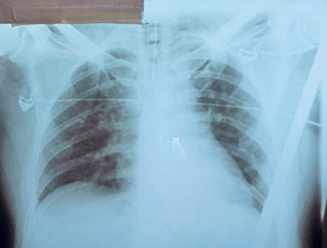 Incredibil! Trăieşte după ce a fost străpuns de un fier!