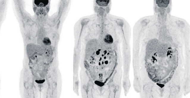 «Vânătorii» de cancer vor folosi medicamente nucleare