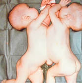 Reunite în suferinţă! Primele siameze despărţite de la noi din ţară sunt din nou împreună