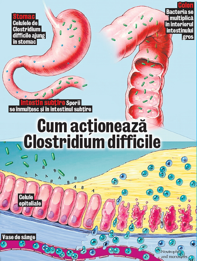 Rudele celor infectaţi, în pericol | Conf. dr. Gabriel Adrian Popescu, specialist la Institutul Naţional de Boli Infecţioase, trage un semnal de alarmă în cazul bacteriei ucigaşe