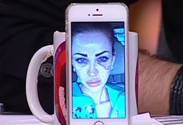 Bianca Drăguşanu, desfigurată după un accident! FOTO