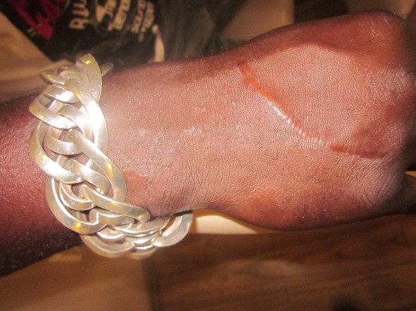 Tăietura de la mâna dreaptă