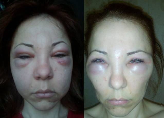 Avocată din Alba Iulia, desfigurată după o intervenție estetică! Ce i-a injectat medicul, în loc de botox? FOTO ȘOCANT