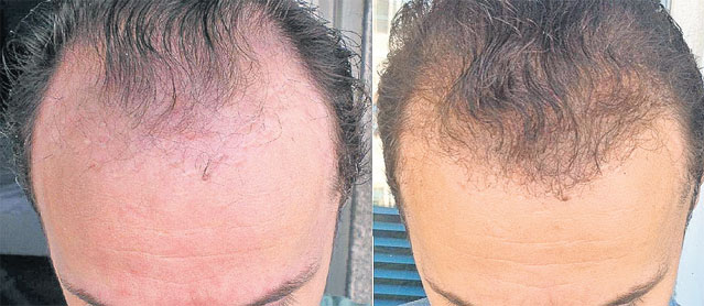 Sunt celebru, mai vreau păr | Mihai Trăistariu s-a programat deja la al patrulea implant | EXCLUSIV