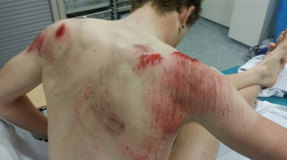 Sam Bennett și-a arătat spatele însângerat