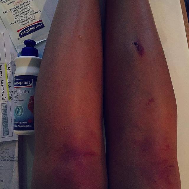 Ups! Mădălina Ghenea s-a accidentat pe platoul de filmare! Uite ce a pățit! FOTO ÎN ARTICOL!