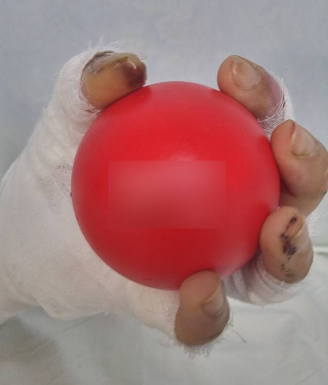 Tragedia din COLECTIV. IMAGINE impresionantă cu unul dintre răniții aflați în spital